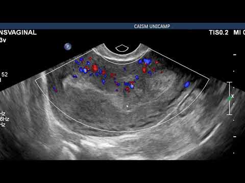 Ultrassonografia transvaginal na avaliação de restos ovulares após aborto espontâneo.