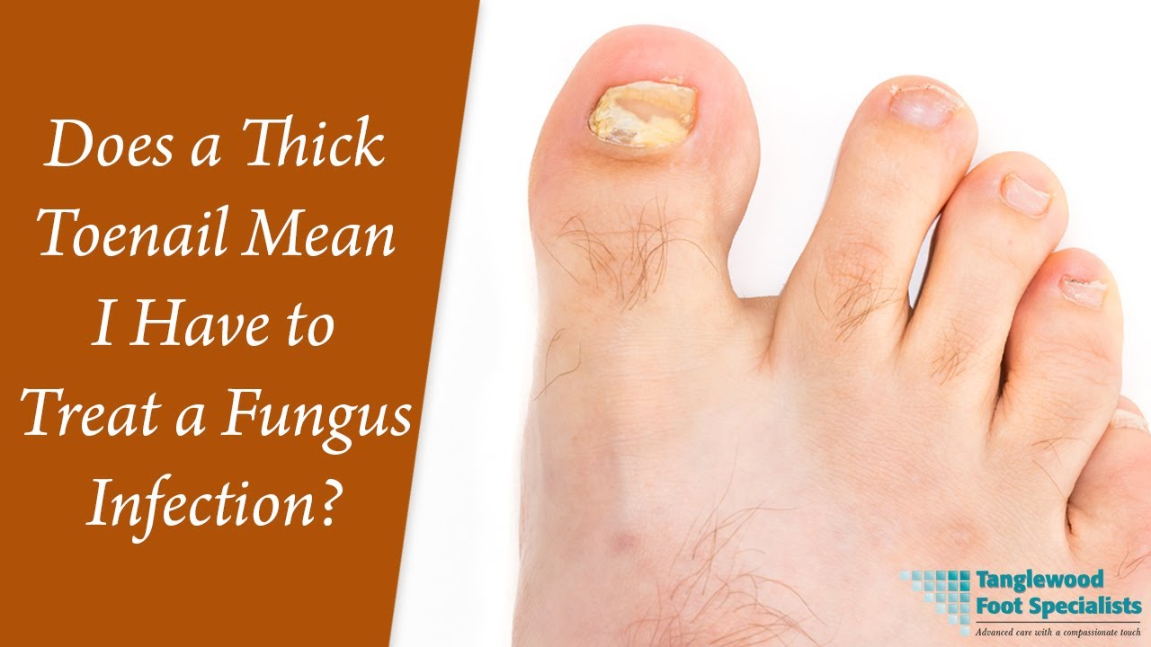 Does a Thick Toenail Mean I Have to Treat a Fungus Infection?