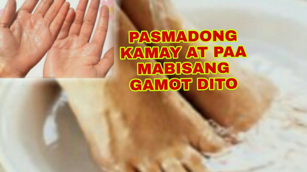 Putar video PASMADONG KAMAY AT PAA MABISANG GAMOT DI To-Apple Paguio7 sekarang PASMADONG KAMAY AT PAA MABISANG GAMOT DI To-Apple Paguio7