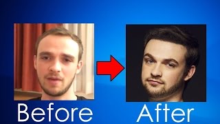 100% PROOF THAT ALI-A HAD A HAIR TRANSPLANT