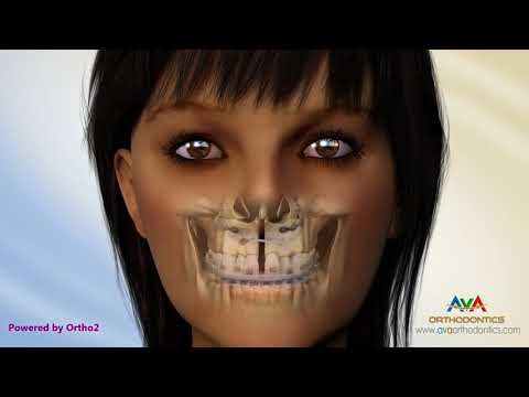 Surgical Orthodontic Treatment for Underbite or Crossbite - 2 piece Maxillary Advancement