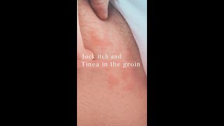 Jock itch and Tinea in the groin | Dr. Anna Chacon