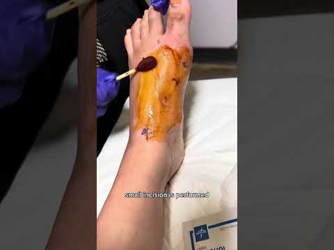 Removing a Painful Pin From a FOOT?! #surgeryday