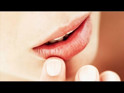 Τι να κάνετε για τις άφθες στο στόμα - Γιατί εμφανίζονται εξαρχής