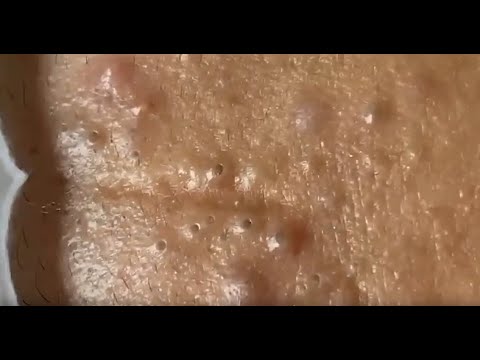 ПРЫЩИ В СОБСТВЕННОМ СОКУ
