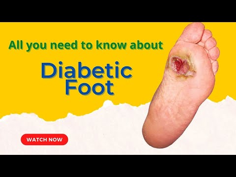 Diabetic Foot: What is diabetic foot | Tips to Manage Diabetic Foot | Dr Chetan Mhaske
