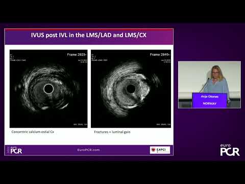 How to integrate intravascular lithotripsy (IVL) into your calcium management - EuroPCR 2022