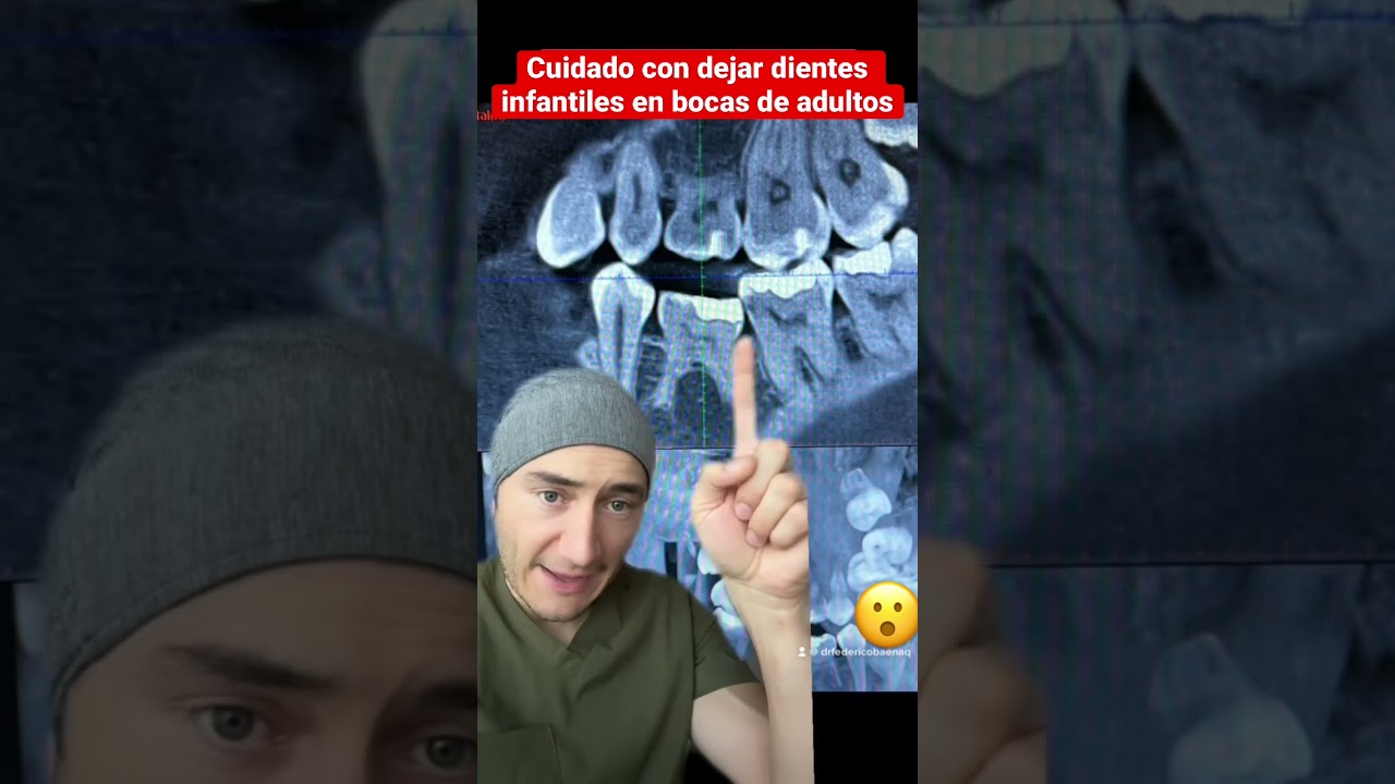 Watch El problema de dejar dientes de leche en adultos. Te explico Now El problema de dejar dientes de leche en adultos. Te explico
