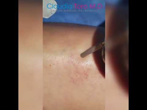 ¿Cómo eliminar las arañitas?  Bogotá Dra. Claudia Toro