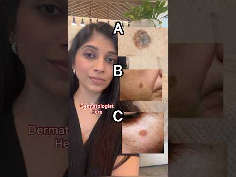 Which One is Melanoma? | Dr. Swati Kannan #shorts