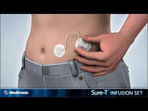 Security

MINIMED™ SURE-T™ INFUSION SET

Thanks to its kink-free needle design and extra adhesive pad, the MiniMed™ Sure-T™ provides extra security against dislodging. It is suitable for children, adults and women during pregnancy up to the second trimester.

Watch this video to learn how to insert the MiniMed™ Sure-T™ infusion set.
