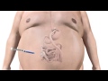 Band Over Bypass Animation