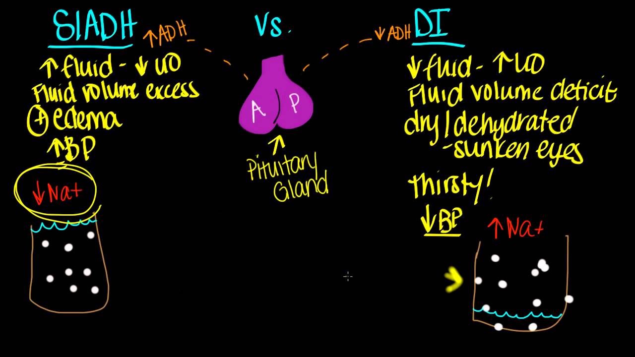 SIADH vs. DI