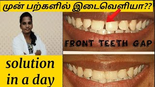 முன் பற்களில் இடைவெளியா???/ front teeth gap solution in a day without braces /smile correction-Tamil
