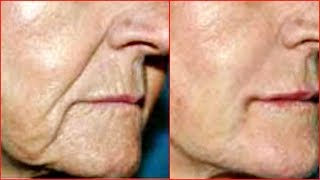 IF ONLY YOU KNEW....  REMOVE DEEP MOUTH WRINKLE, UPPER LIPS HOMEMADE REMEDY Khichi Beauty