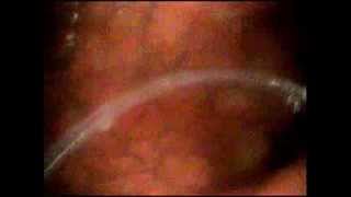 preview picture of video 'Intragastric balloon ( MedSil ) بالون المعدة'