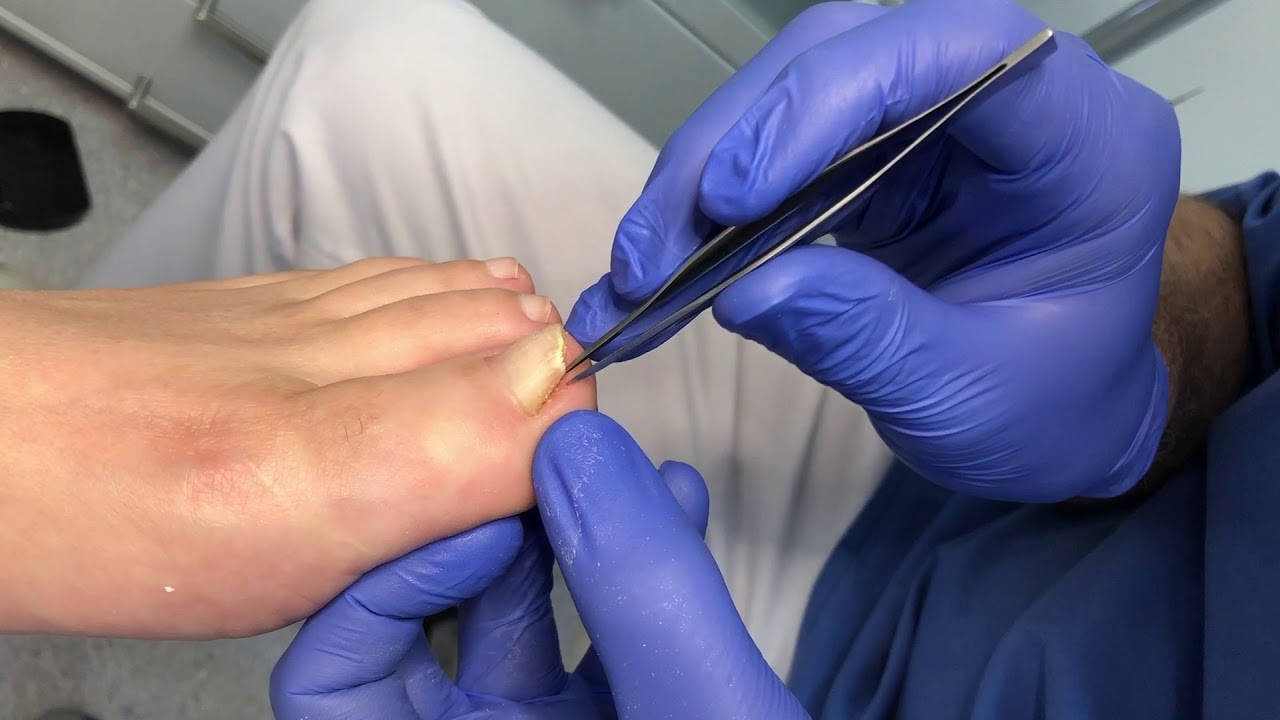 Wygojony wrastający paznokieć i aplikacja klamry Frasera