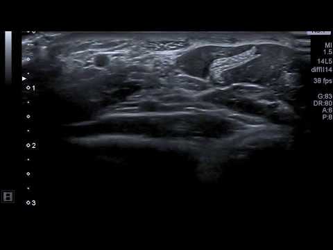 Das beste Mittel für eine hypertensive Krise Lebensmittel für Hypertonie Joghurt