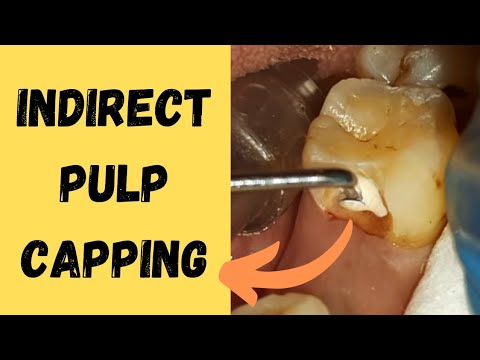 indirect pulp capping | Clinical case | Using Dycal | Dental ji