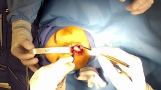 preview picture of video 'Open Rhinoplasty - (Part 3) Evaluation of Nasal Tip Cartilages Chevy Chase Maryland'