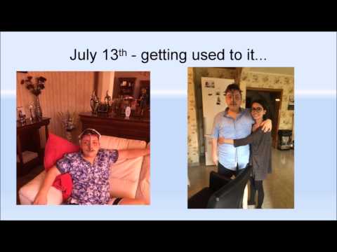 LeFort III Osteotomy - My Story