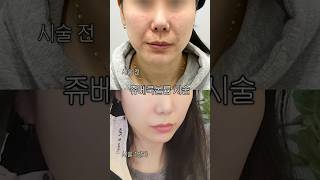 쥬베룩볼륨은 자연스럽게 사라질까?