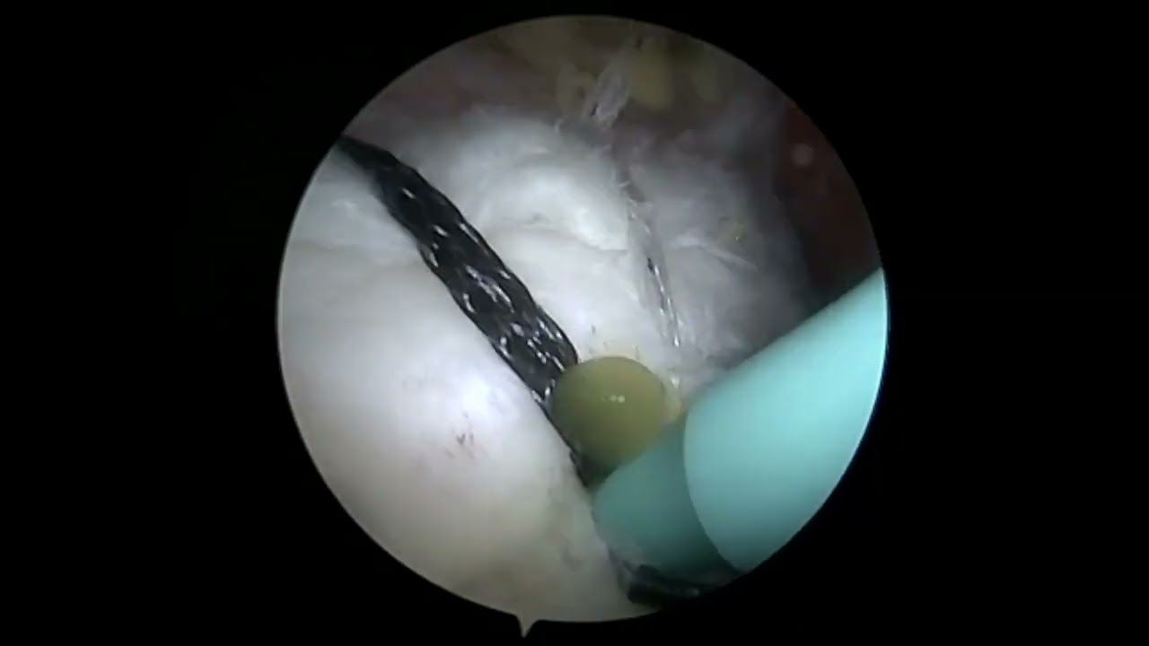 Dr. Garcia update rotator cuff repair technique.