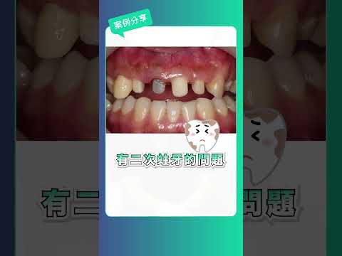【前牙植牙】假牙十幾年後牙齦發黑？前牙美學植牙案例大公開，補骨補肉重返自然自信笑容！｜Dent&amp;Co牙醫小幫手 x 品登數位美學牙醫 蔡秉勳院長
