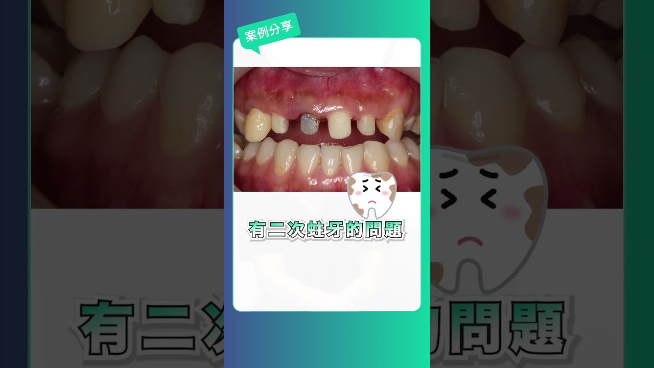 【前牙植牙】假牙十幾年後牙齦發黑？前牙美學植牙案例大公開，補骨補肉重返自然自信笑容！｜Dent&amp;Co牙醫小幫手 x 品登數位美學牙醫 蔡秉勳院長