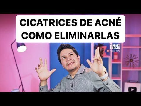 CICATRICES DE ACNE COMO ELIMINARLAS