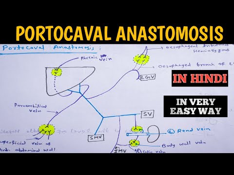 Portocaval Anastomosis | Caput medusae | Oesophageal varices | Portacaval anastomoses in easy way