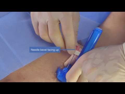 AxoTrack Procedure Video: Subclavian