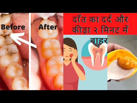 दांत दर्द से छुटकारा मिनटों में, दांतों के कीड़ों से छुटकारा,मसूड़ों में सूजन सब होगा ठीक इस उपाय से