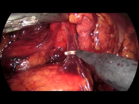 Laparoscopic Gastrectomy With En Bloc D2 Lymphadenectomy