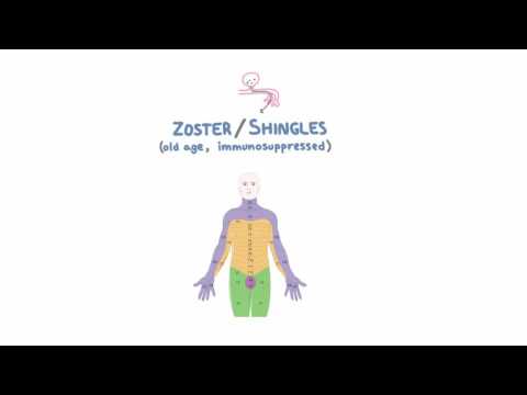VZV - Clinical Presentation of Chicken Pox and Shingles