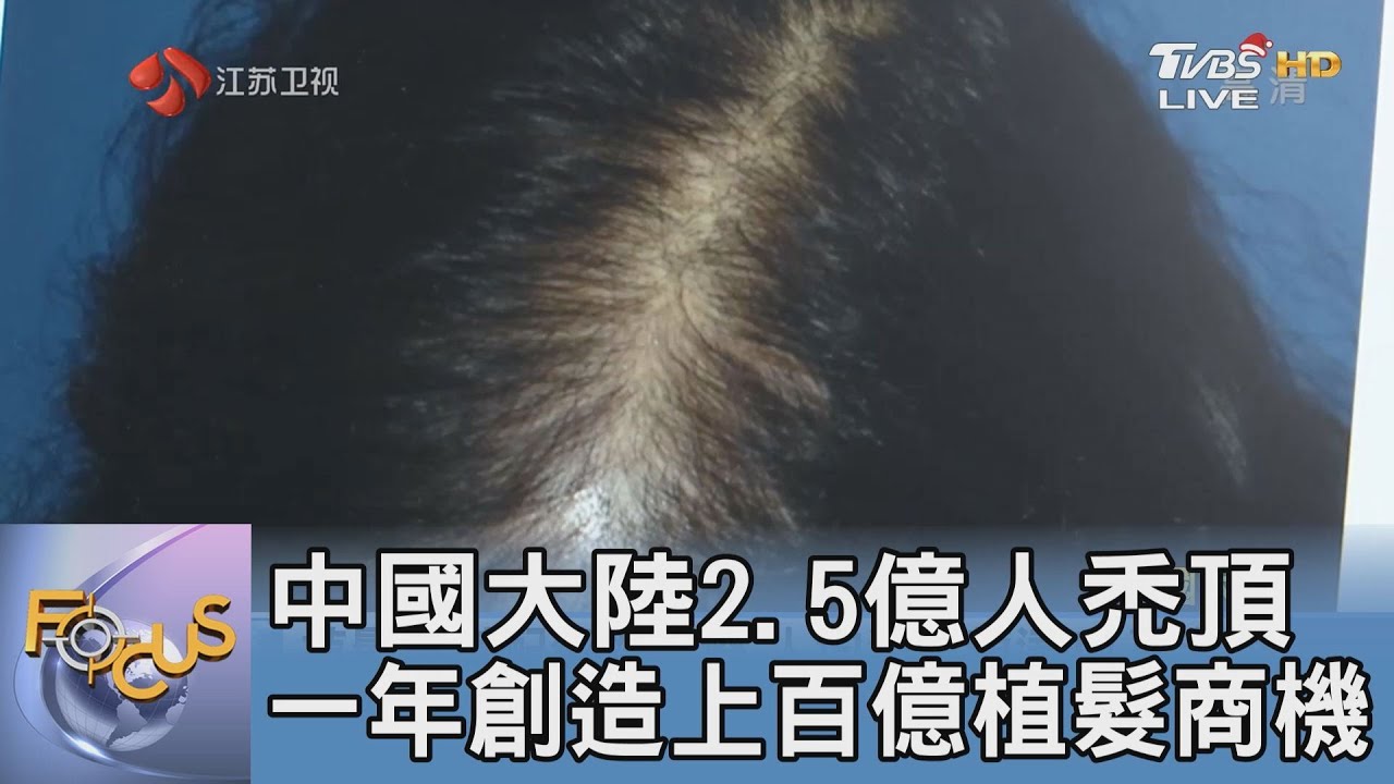 中國大陸2.5億人禿頂 一年創造上百億植髮商機