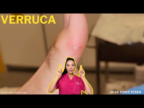 Quick & Effective Verruca Removal: Advanced Treatments Explained | Miss Foot Fixer