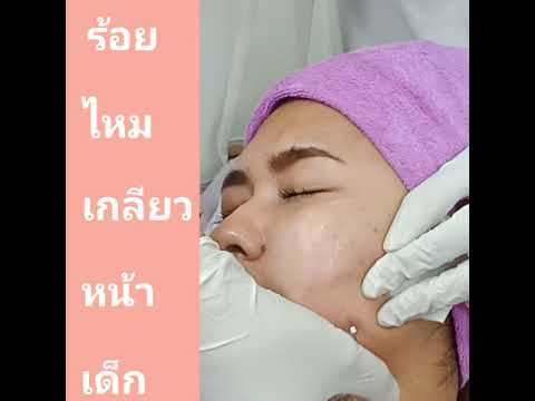 ร้อยไหม หน้าเรียว