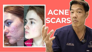 The Best Acne Scar Treatments: Explained | Dr Davin Lim