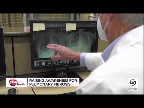 New drug slows scaring of the lungs due to pulmonary fibrosis