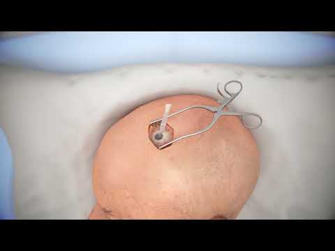 Ventriculostomy Brain Surgery - 3d animation