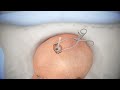 Ventriculostomy Brain Surgery - 3d animation