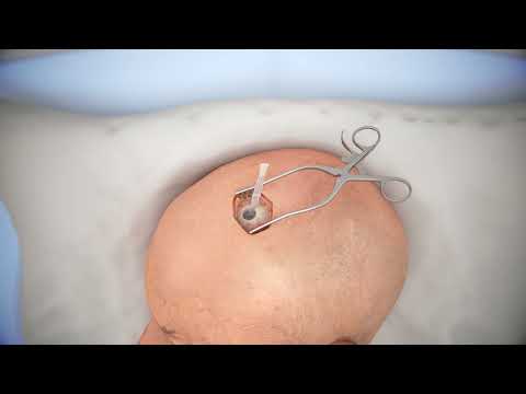 Ventriculostomy Brain Surgery - 3d animation Video