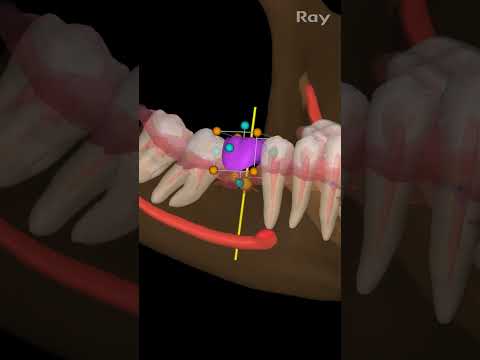 SMARTDent : 5D Tutorial #3-4. Top-Down Implant Planning
