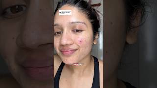 Pimple patch Peel, now what? Here’s how I treat the spot so it heals faster and avoids dark marks 💛