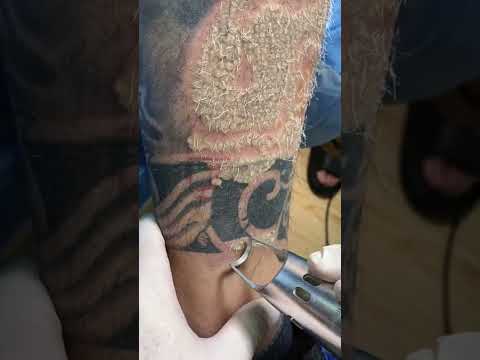 , title : 'SCAR FREE TATTOO REMOVAL - ep1968 #short'