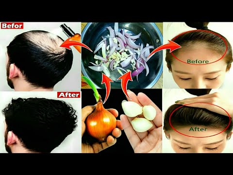 99% of People Don’t Know This Garlic & Onion Recipe to Thicken Hair in Just 7 Days