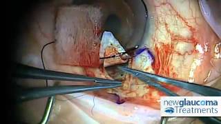 Canaloplasty Glaucoma Surgery Using Mastel Instruments: Part 4 - Suture