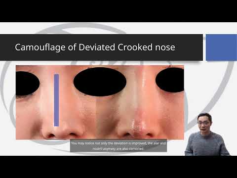 Nasion Hump and Crooked Nose  - Structural approach for COG thread rhinoplasty 4/8