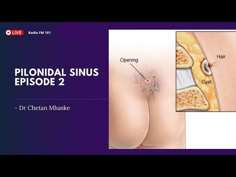 What is Pilonidal Sinus? Treatment - Dr. Chetan Mhaske
